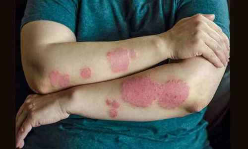 Psoriasis Treatment Services