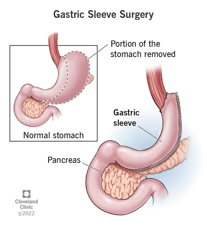 Bariatric Surgery