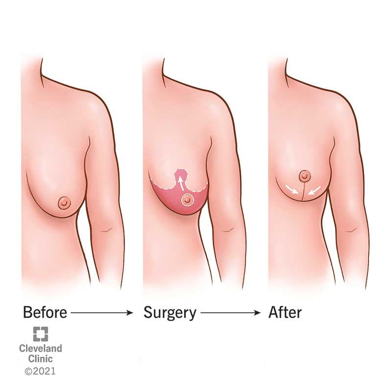 Breast Lift Surgery