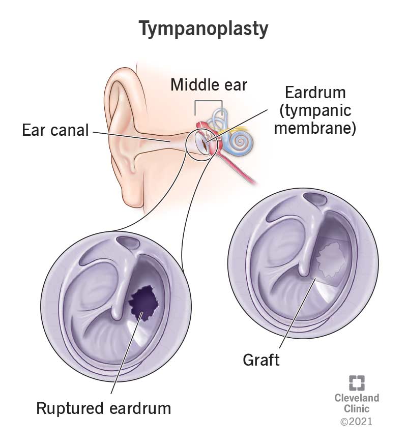 Ear Surgery