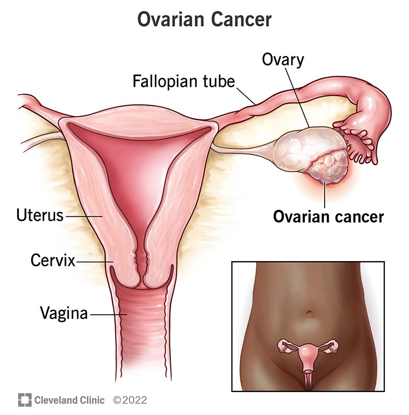 Ovarian Cancer Treatment