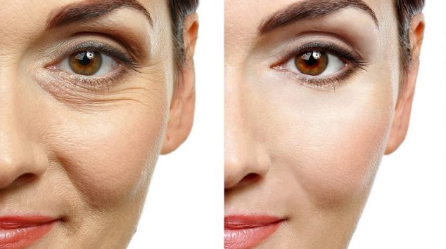 Botox Treatment