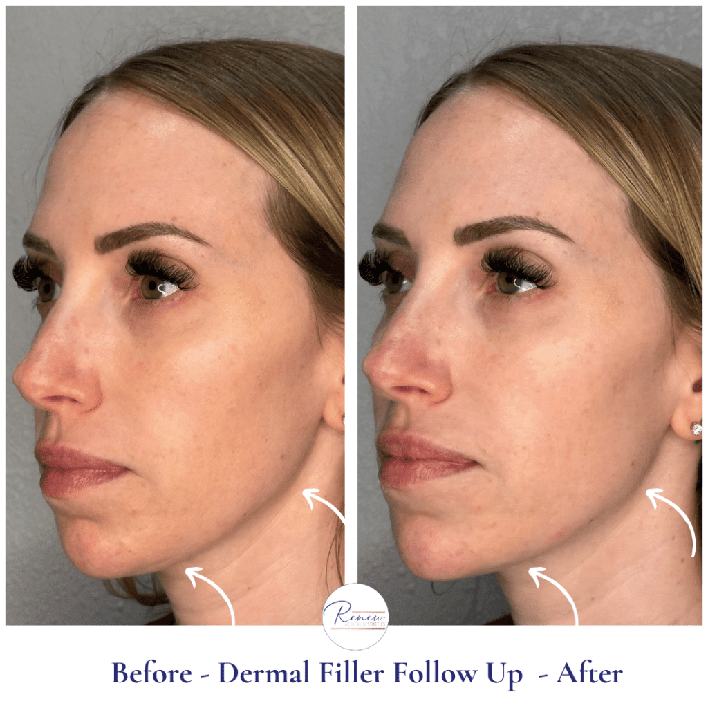 Cosmetic Fillers