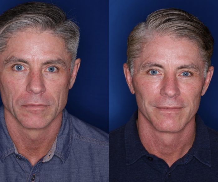 Face Lift Surgery