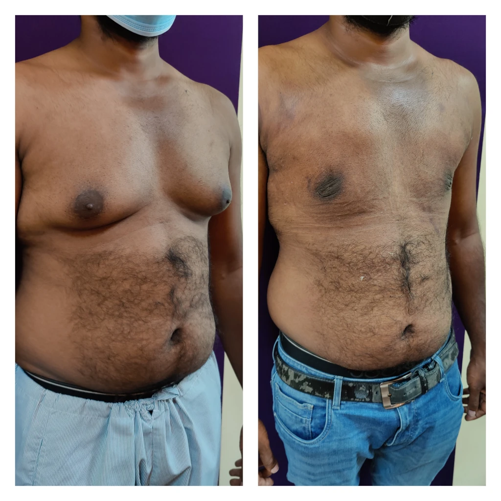 Gynecomastia Surgery