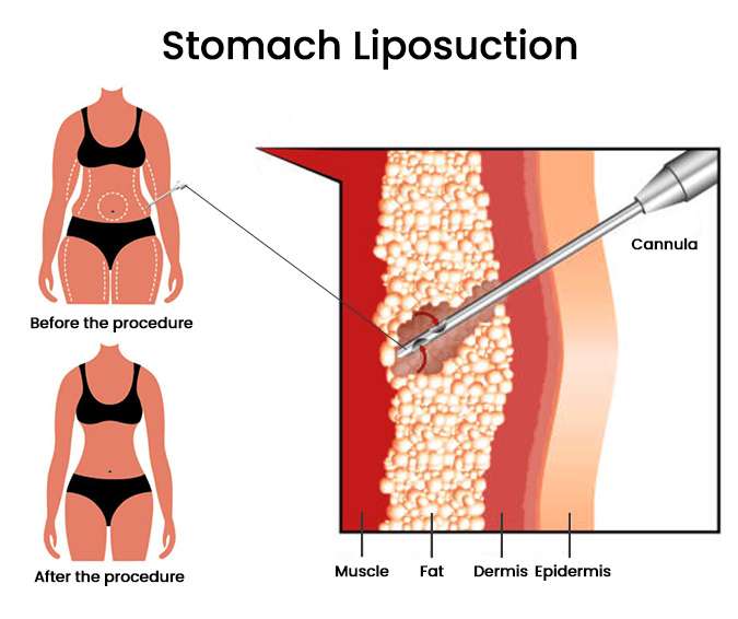 Liposuction Surgery