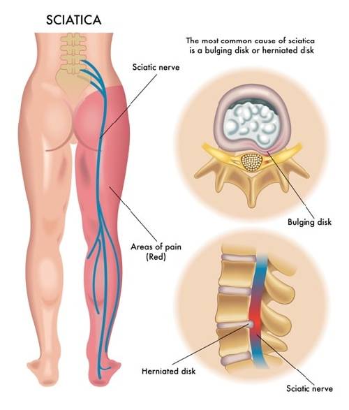 Sciatica Treatment