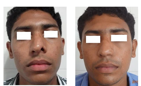 Nose Treatment Services