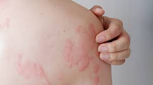 Urticaria Treatment