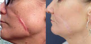 Scar Treatment