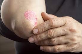 Psoriasis Treatment Services