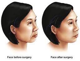 Face Lift Surgery