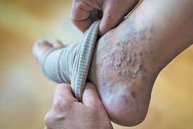 Varicose Veins Treatment