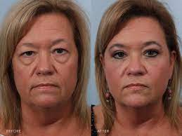 Eyelid Surgery