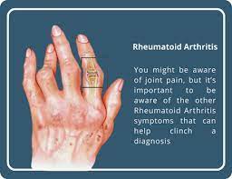 Rheumatoid Arthritis Treatment