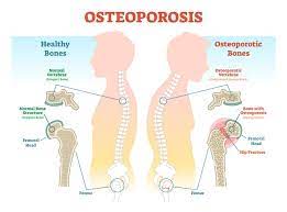 Osteoporosis Treatment