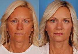 Blepharoplasty Surgery