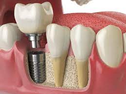 Dental Implant Surgery