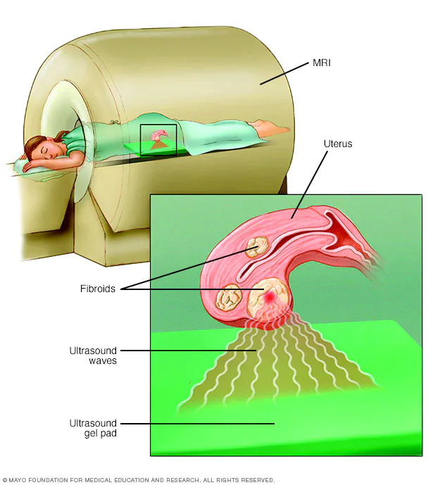 Fibroid Treatment