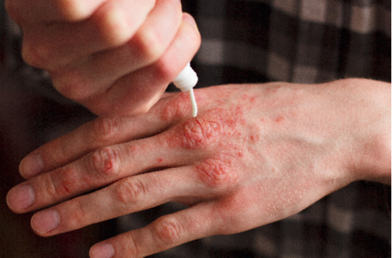 Eczema Treatment Services