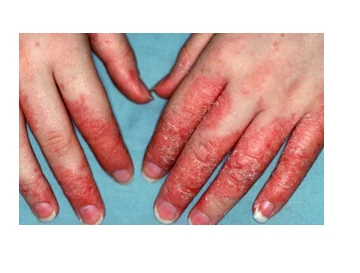 Eczema Treatment Services