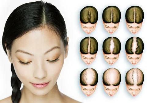 Baldness Treatment