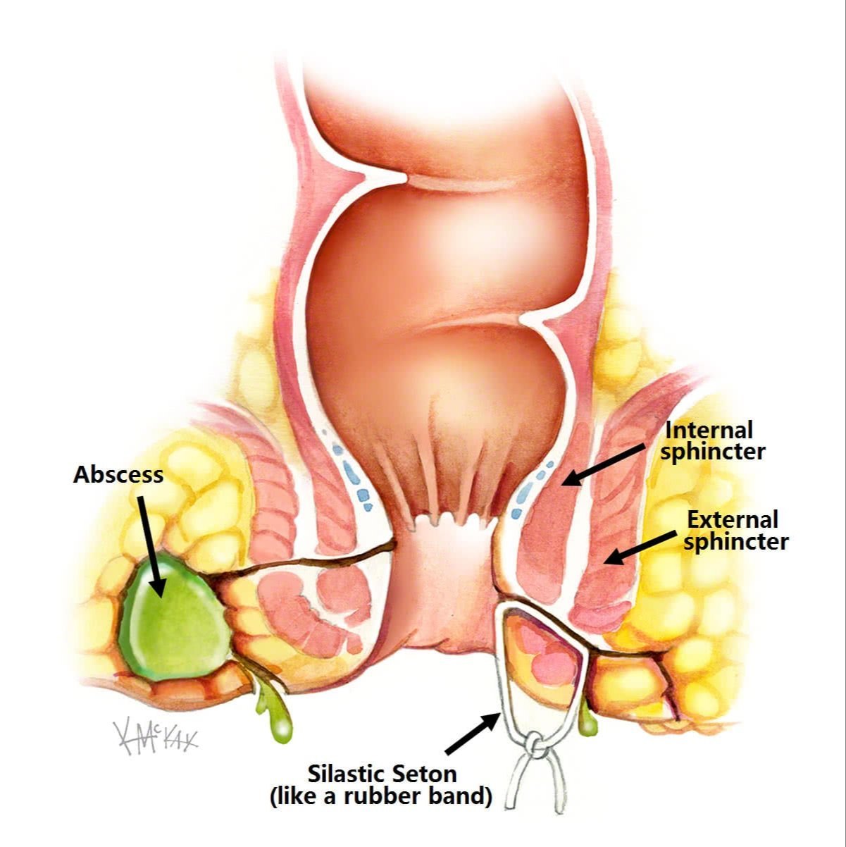 Fistula Treatment