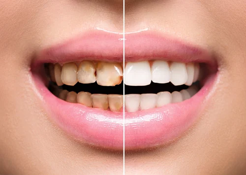 Full Mouth Rehabilitation Service