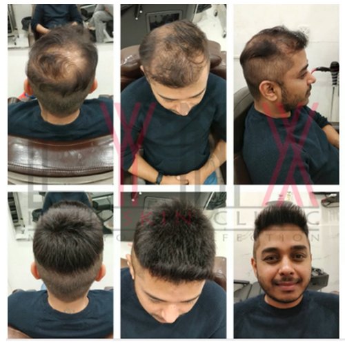 Hair Replacement Services