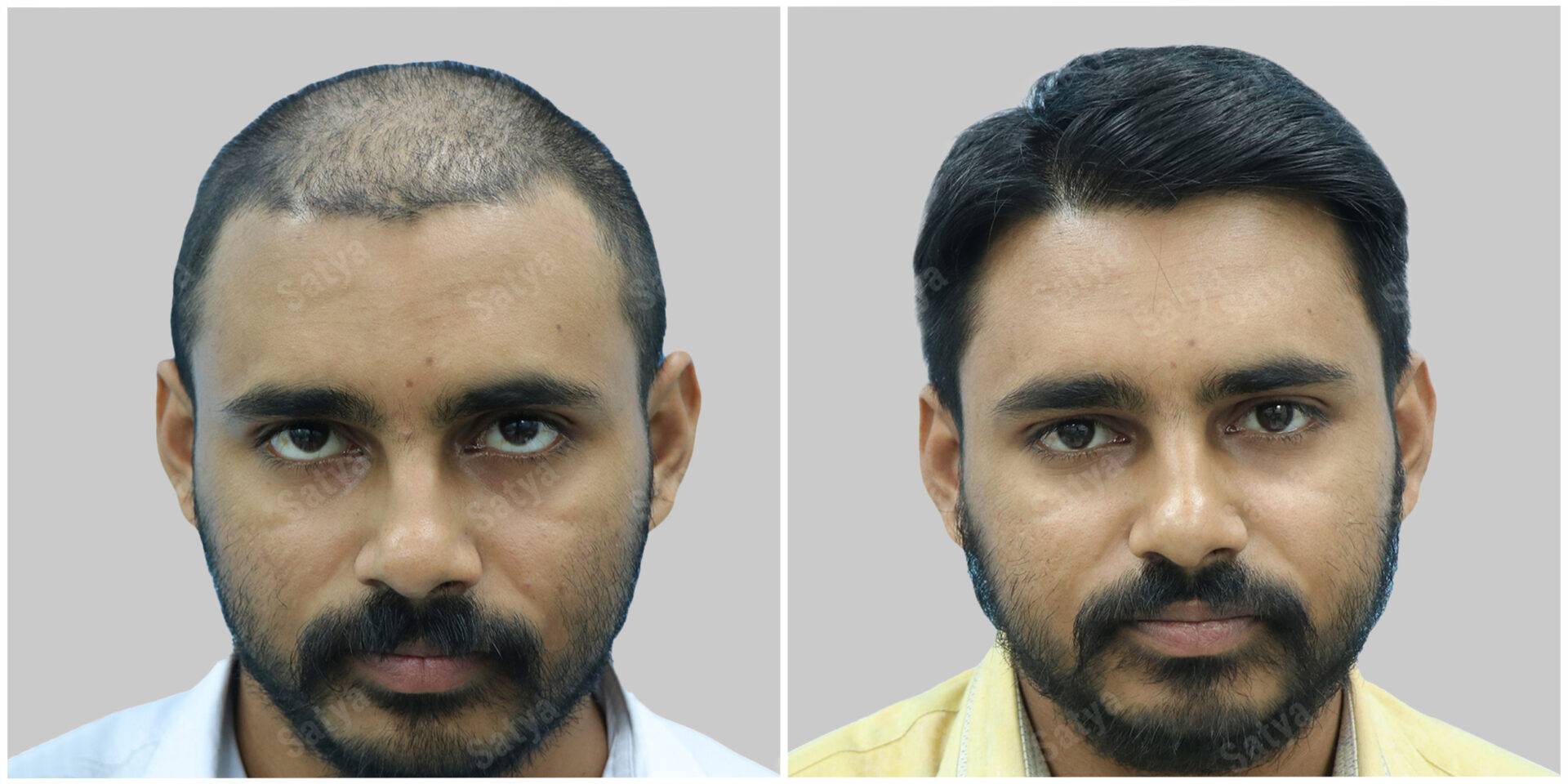 Hair Transplantation