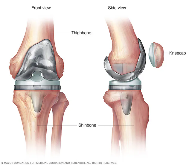 Joint Replacement Surgery