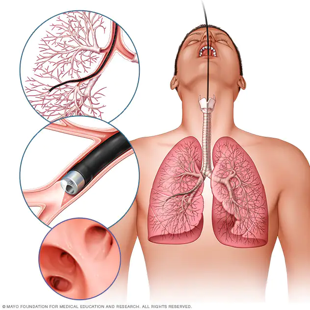 Lung Cancer Treatment