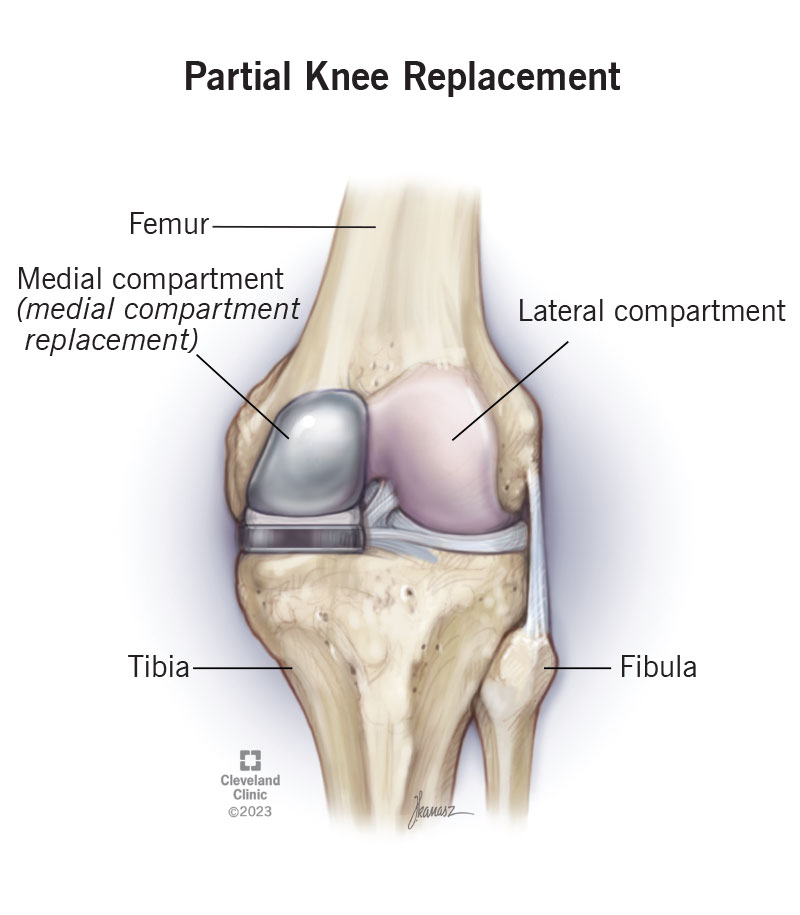 Knee Replacement Surgery